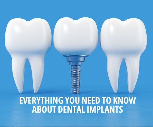 Dental implants