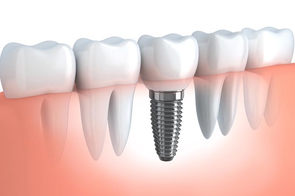 Dental Implants