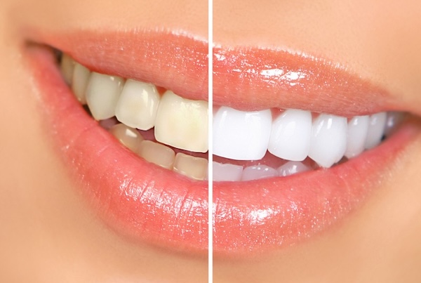 Teeth Whitening