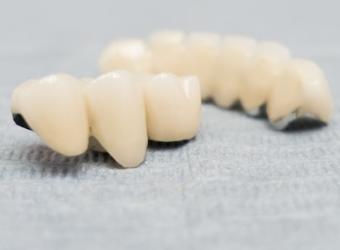 Understanding the benefits of crowns and bridges