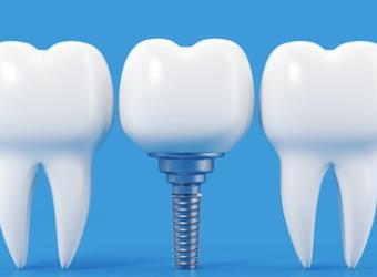 Everything you need to know about dental implants