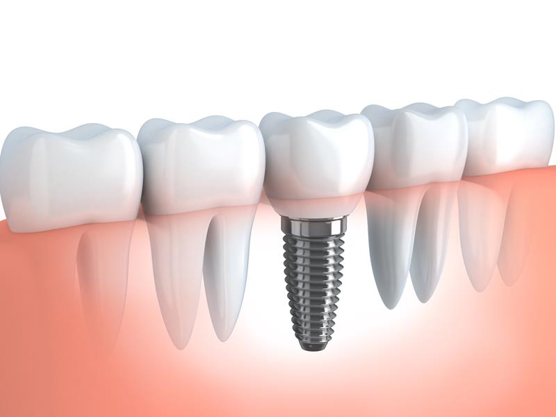 Dental Implants  Glen Rock, NJ 
